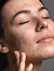 piel acne dermocosmetica solucion sf skin