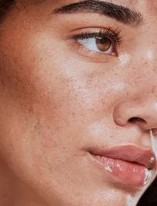 sf skin piel pigmentada